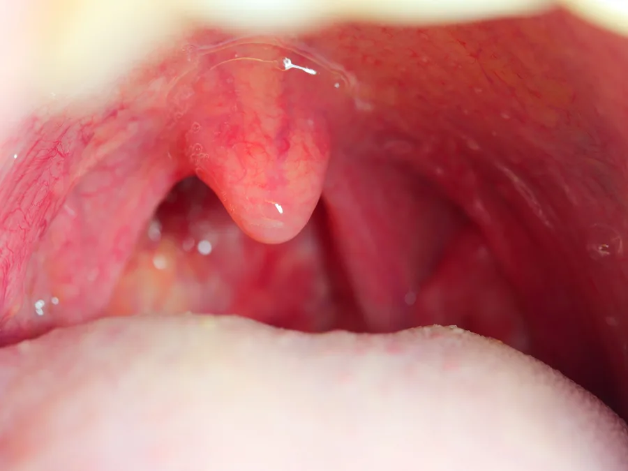 Throat examination (stock image)